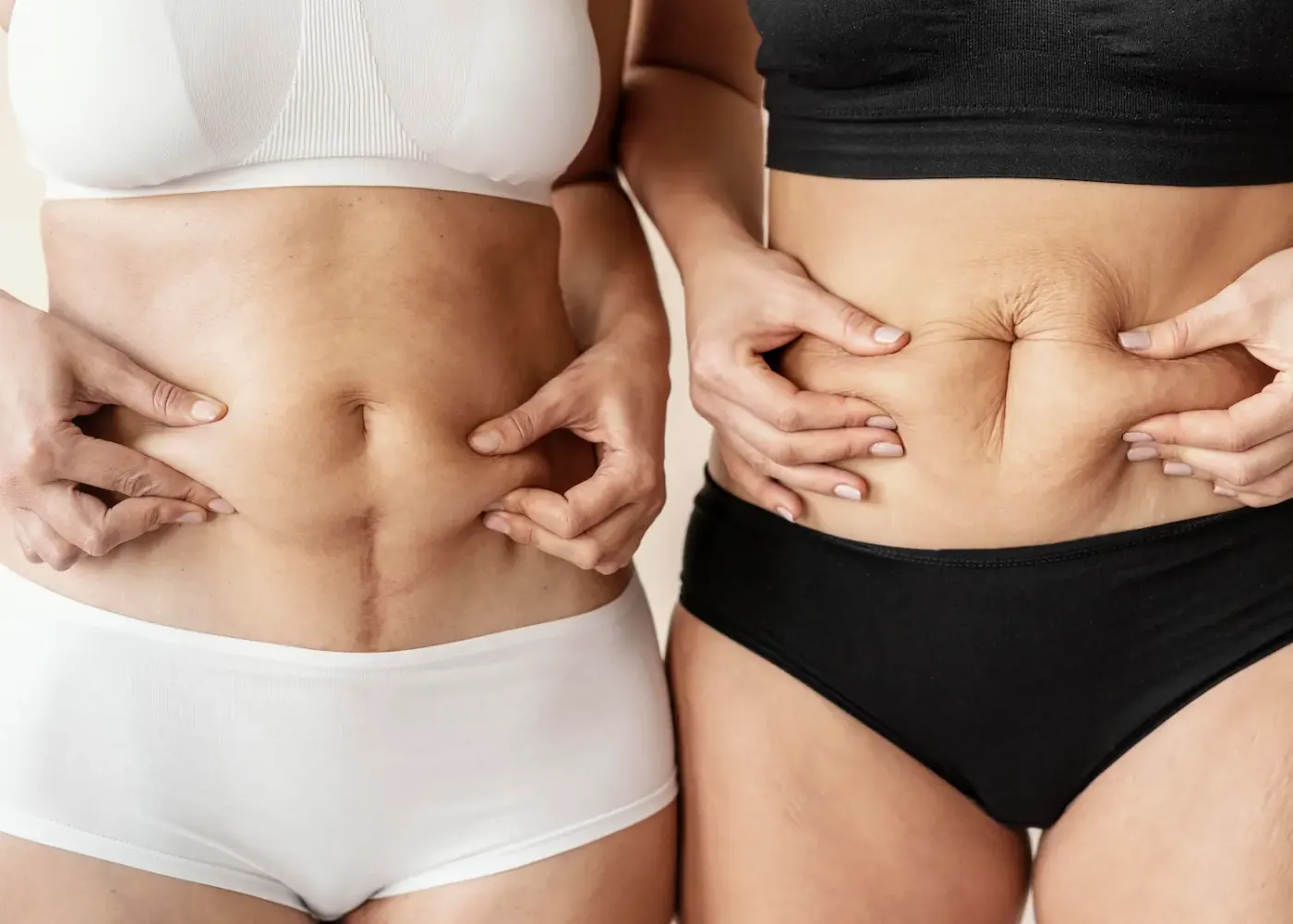Por que a lipoaspiração não emagrece?